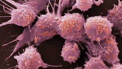 Cellules cancéreuses de la prostate au microscope électronique : grâce à un meilleur screening, les chercheurs pourront à l'avenir identifier de nouvelles thérapies contre le cancer.