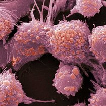 Cellules cancéreuses de la prostate au microscope électronique : grâce à un meilleur screening, les chercheurs pourront à l'avenir identifier de nouvelles thérapies contre le cancer.