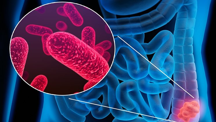 L’IA permet de détecter le cancer colorectal grâce aux bactéries intestinales.