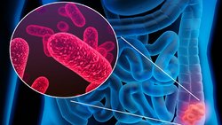 L’IA permet de détecter le cancer colorectal grâce aux bactéries intestinales.