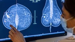 En 2022, les maladies non transmissibles telles que le cancer ont engendré des coûts de 65,7 milliards de francs: examen des seins d'une femme à la recherche d'un cancer du sein par mammographie.