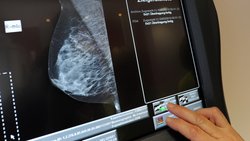 FeminaVita prend en charge les examens gynécologiques préventifs et les dépistages du cancer du sein sans franchise.