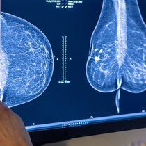 En 2022, les maladies non transmissibles telles que le cancer ont engendré des coûts de 65,7 milliards de francs: examen des seins d'une femme à la recherche d'un cancer du sein par mammographie.